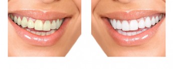 FUN but REAL: Weiße Zähne sind schöner als hellgraue – dasselbe trifft auf Anschlussklemmen zu